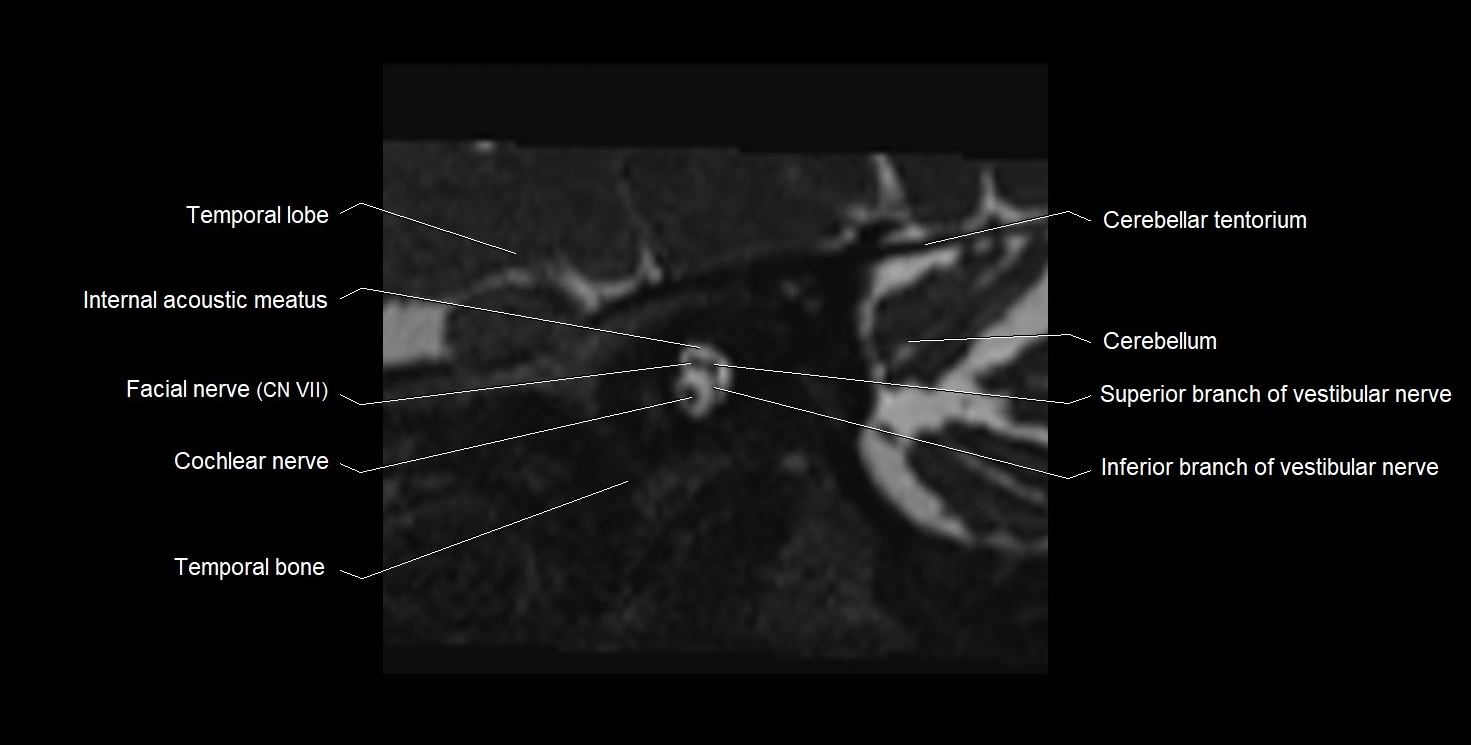 Internal auditory meatus (IAM) 3T sagittal cross sectional anatomy image 14.webp